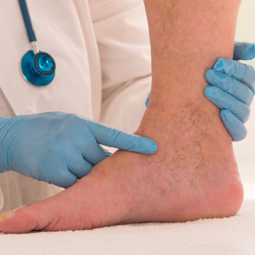 Examen vasculaire d'un pied